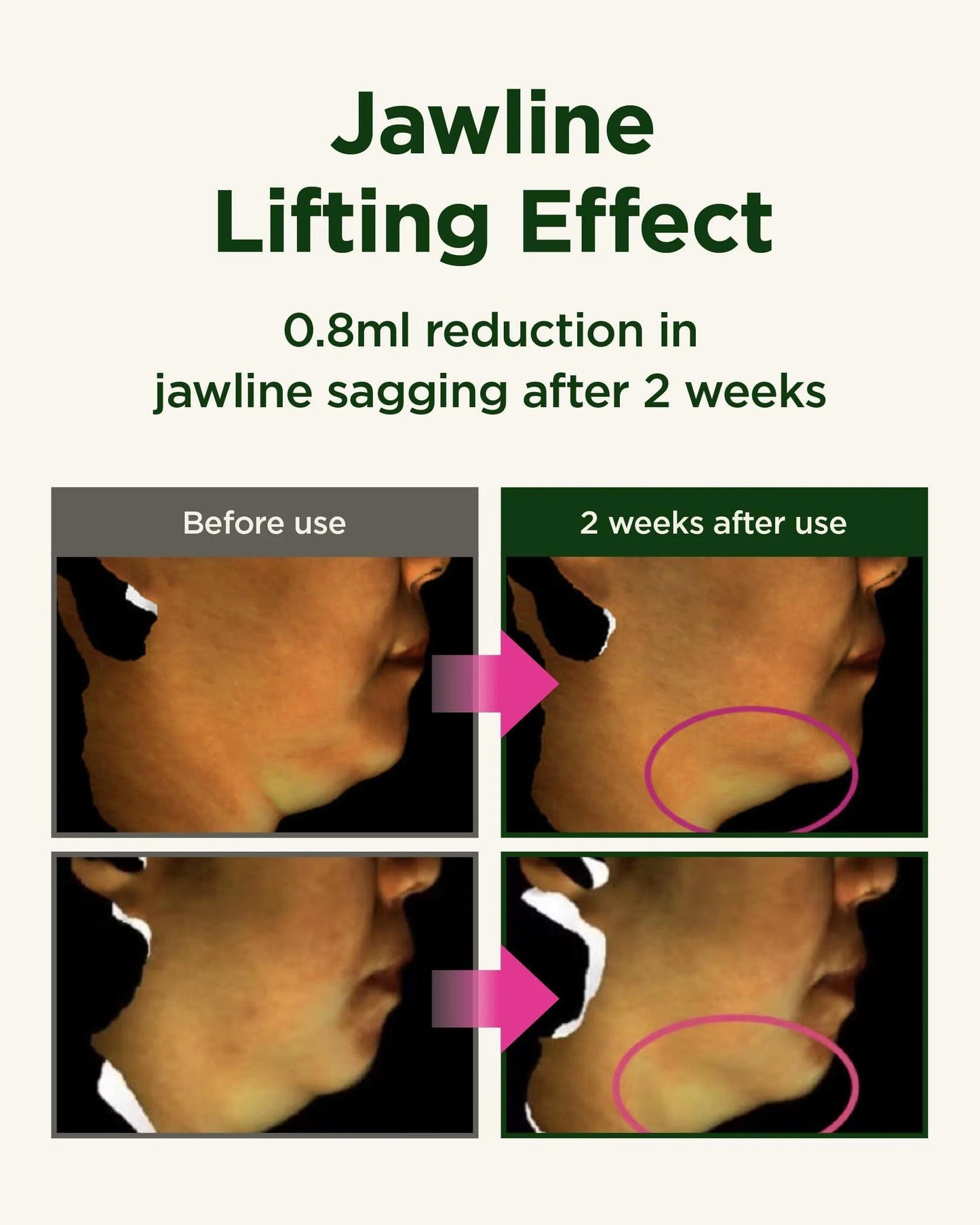 Neck wrinkle reduction comparison with before-and-after skin results