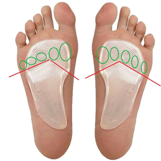 Clear metatarsal raise inserts under toes on bare feet, forefoot support pad set