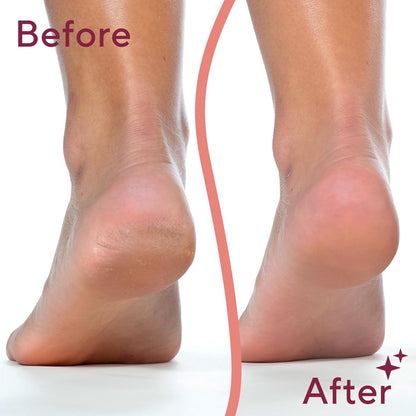 Foot Repair - Rechargeable Electric Callus Remover - Removes Dry Skin - For Smoother Feet