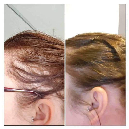 Hair growth serum on scalp, split view showing hair growth on two sides
