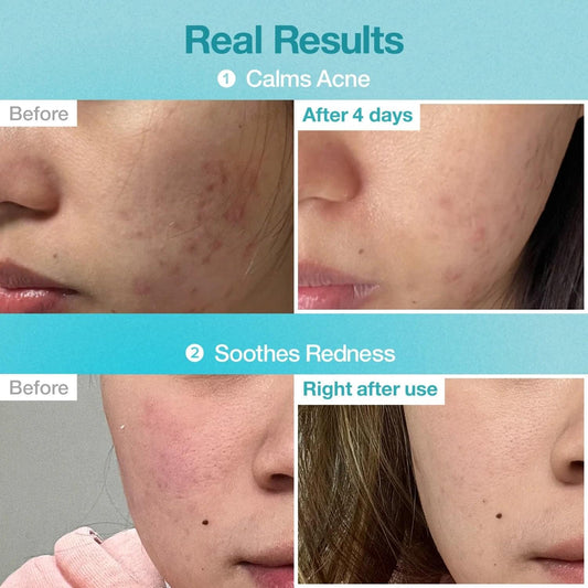 Acne before-and-after skin results collage for No.1 sheet mask