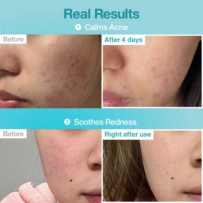 Before-and-after acne calming results for a skin patch over two days