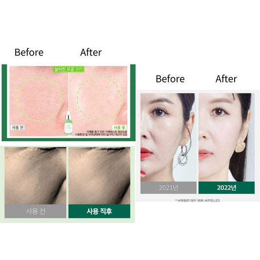Before-and-after skin pore results with ampoule, split-face comparison